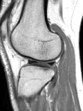 膝関節（プロトン密度強調画像）