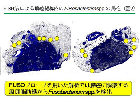 （図2）FISH法による膵癌組織内のFusobacteriumspp.の局在