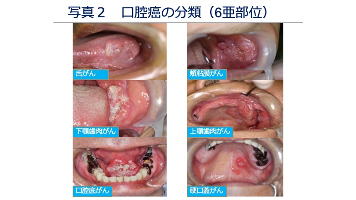 写真2 口腔がんの分類（6亜部位）