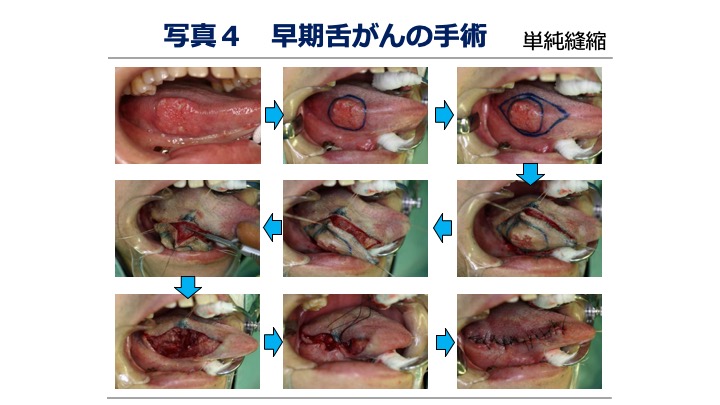 写真4 早期舌がんの手術（単純縫縮）