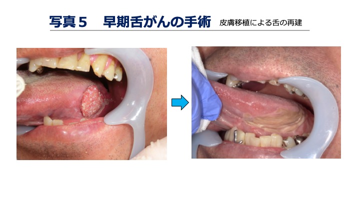 写真5 早期舌がんの手術（皮膚移植による舌の再建）