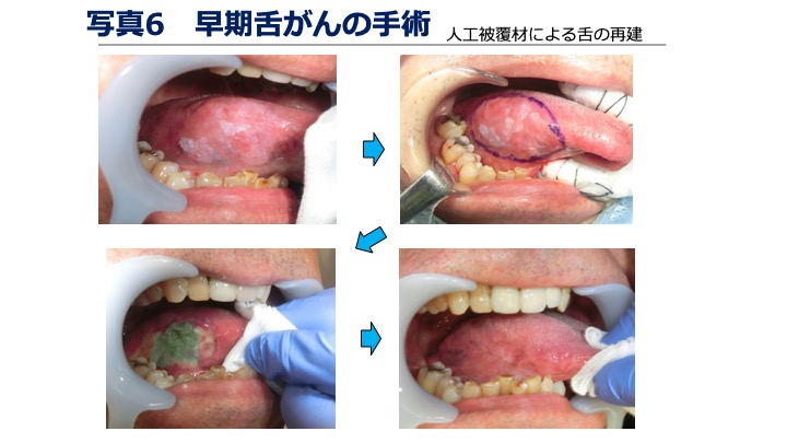 写真6 早期舌がんの手術（人口覆材による舌の再建）