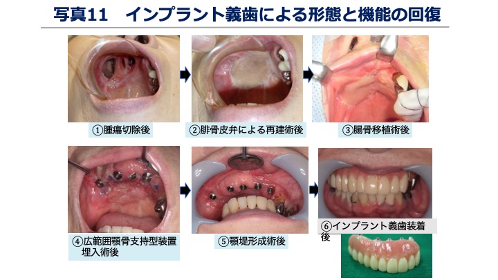 写真11 インプラント義歯による形態と機能の回復