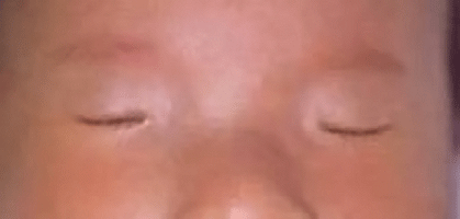瞼裂狭小症候群の典型例の画像