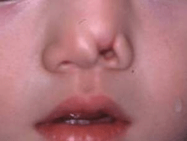 側鼻裂の典型例の画像