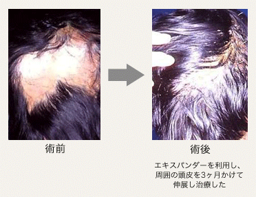 熱傷による脱毛の治療例1
