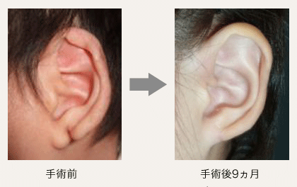 耳垂裂の画像