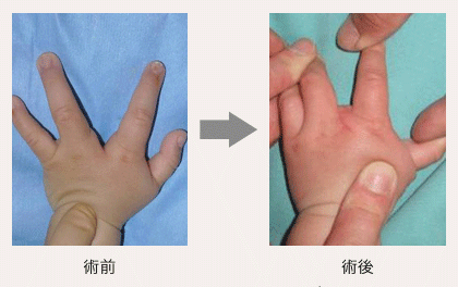 裂手症の治療例の画像