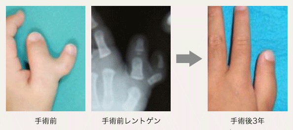 左母指多指症の画像