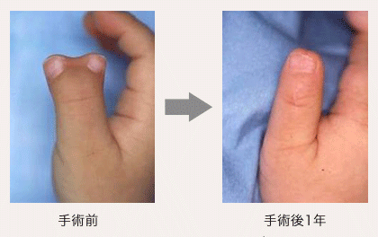 右母指多指症の画像