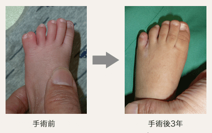 右4-5趾合趾症・5趾多趾症の画像