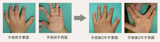 左中指-環指合指症の画像