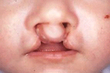 口唇裂の画像