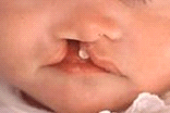 口唇裂の画像