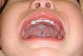 口蓋裂の画像