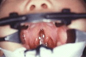 口蓋裂の画像