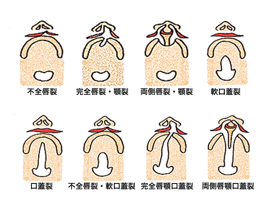 口唇裂、顎裂、口蓋裂発生の種々の形態の画像