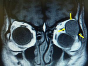 眼窩内腫瘍の画像