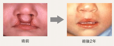 両側唇裂の画像
