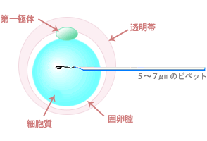顕微受精(ICSI)
