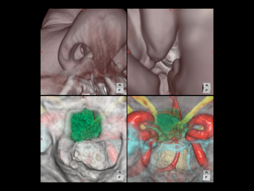 鼻の穴から内視鏡を挿入して下垂体腫瘍を摘出する手術支援3Dシミュレーション画像