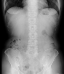 腹部X線写真