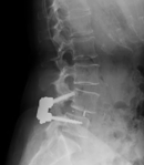 腰椎X線写真