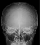 頭部X線写真