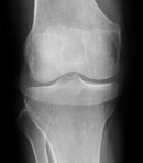 膝X線写真