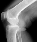 膝X線写真