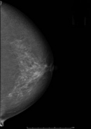 乳房X線写真