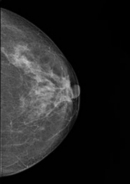 乳房X線写真