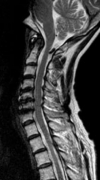 頚椎（T2強調画像）