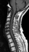 頚椎（T1強調画像）