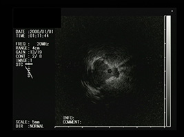 EBUS-GSによる腫瘍の描出