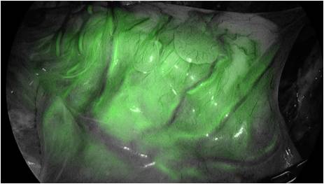 血流良好例：ICG近赤外光観察で腸管は 全体的に緑に観察できる