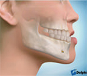 顎変形症の画像1