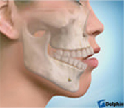 顎変形症の画像2