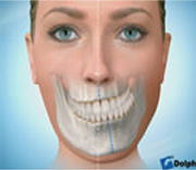 顎変形症の画像3