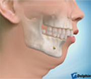 顎変形症の画像4