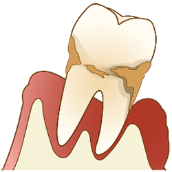 歯周病のイメージイラスト
