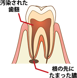 根尖性歯周炎・歯槽膿瘍のイメージイラスト