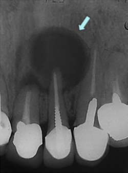 歯根嚢胞のX線画像