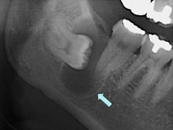 含歯性嚢胞のX線画像