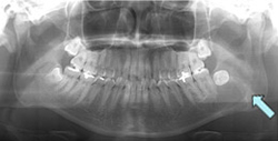 歯原性角化嚢胞のX線画像