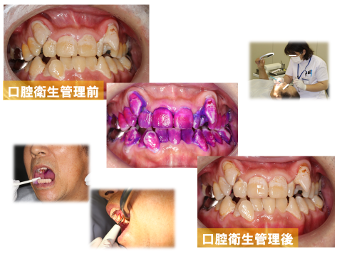 口腔衛生管理のイメージ画像