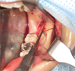 部分的骨切り抜歯法の写真1