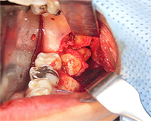 部分的骨切り抜歯法の写真2