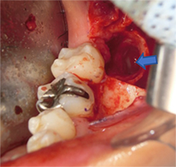 部分的骨切り抜歯法の写真3