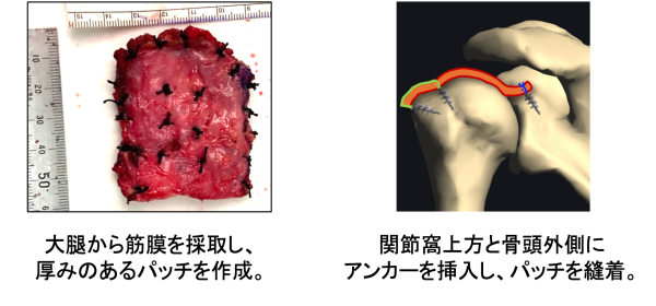 パッチ